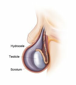 Illustration of hydrocele